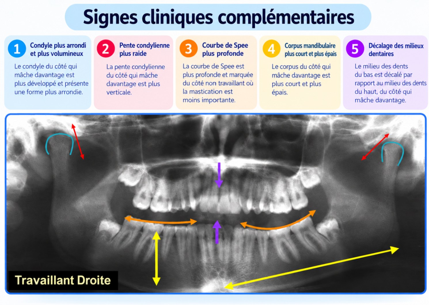 Radiographie panoramique annotée des signes d’une mastication d’un seul côté